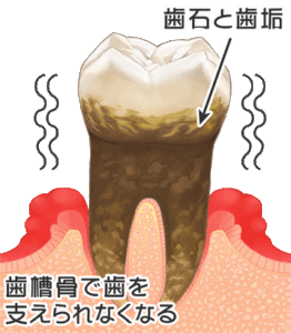 歯周病・歯槽膿漏の原因｜香川県 高松市 歯周病治療 吉本歯科医院