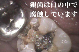 銀歯の下は虫歯になりやすい理由｜香川県 高松市 吉本歯科医院
