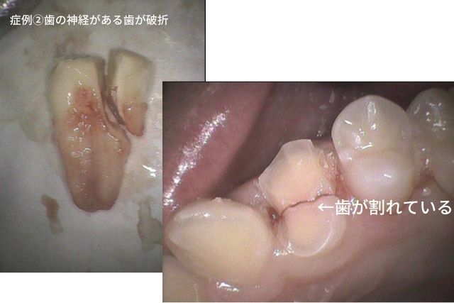 歯が割れる・歯が折れる・歯にヒビ・歯根破折｜香川県 高松市 吉本歯科医院