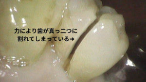 歯根破折｜歯を抜かずに残す治療なら香川県 高松市 吉本歯科医院