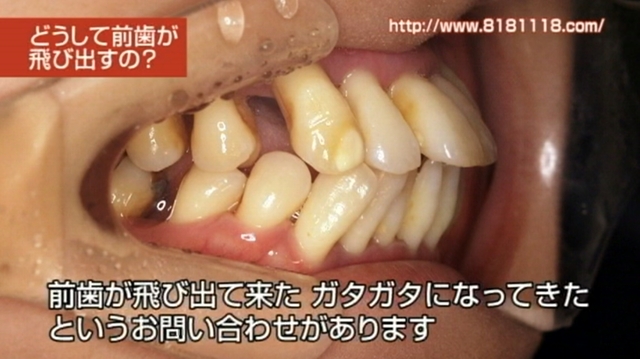 歯が伸びてくる原因｜香川県 高松市 咬み合わせ専門 吉本歯科医院