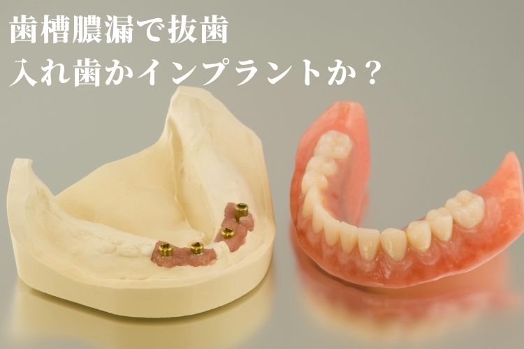 歯槽膿漏で抜歯。入れ歯かインプラントかどちらがいい｜香川県 高松市 吉本歯科医院