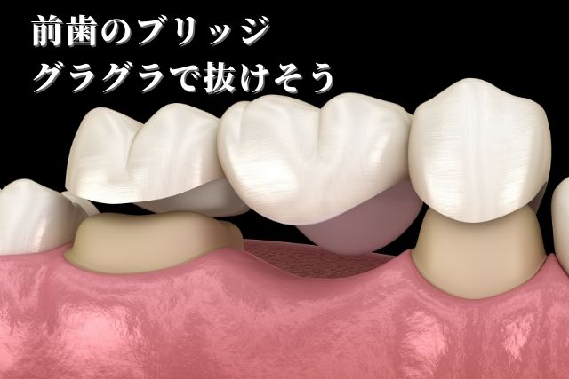 前歯のブリッジがグラグラで抜けそう・治療法は？｜香川県 高松市 吉本歯科医院