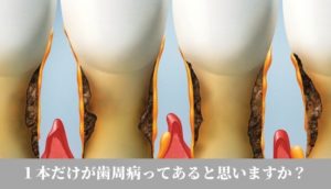 歯周病治療・歯槽膿漏の治療なら香川県 高松市 吉本歯科医院