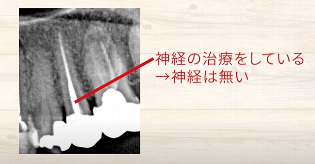 歯の神経のお痛みなら香川県高松市の歯の神経治療専門歯科 吉本歯科医院