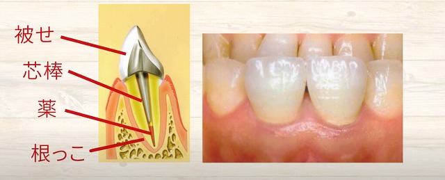 歯の神経のお痛みなら香川県高松市の歯の神経治療専門歯科 吉本歯科医院
