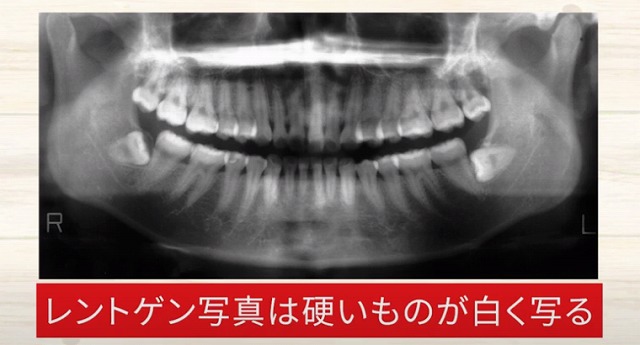 歯の神経を残す治療なら香川県の吉本歯科医院