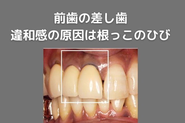 前歯の差し歯に違和感｜原因は歯の根っこのひびわれ｜香川県高松市の吉本歯科医院