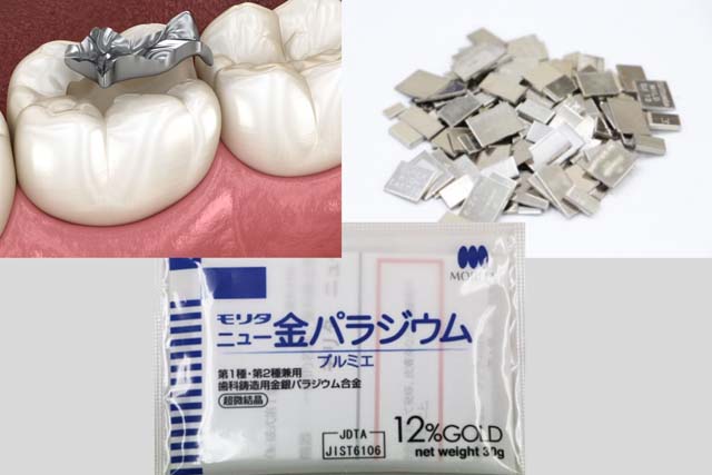 銀歯の下は虫歯になりやすい理由｜香川県 高松市 吉本歯科医院