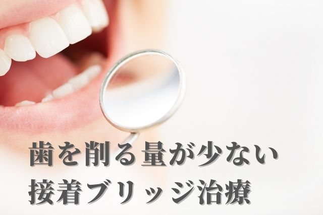 歯を削る量が少ない接着ブリッジ治療なら 香川県 高松市 吉本歯科医院
