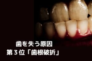 歯根破折｜歯の根っこにひび｜抜歯かどうかの診断は香川県高松市の吉本歯科医院