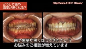 神経を取った歯が変色しているのを白くしたい｜香川県 高松市 審美歯科なら吉本歯科医院