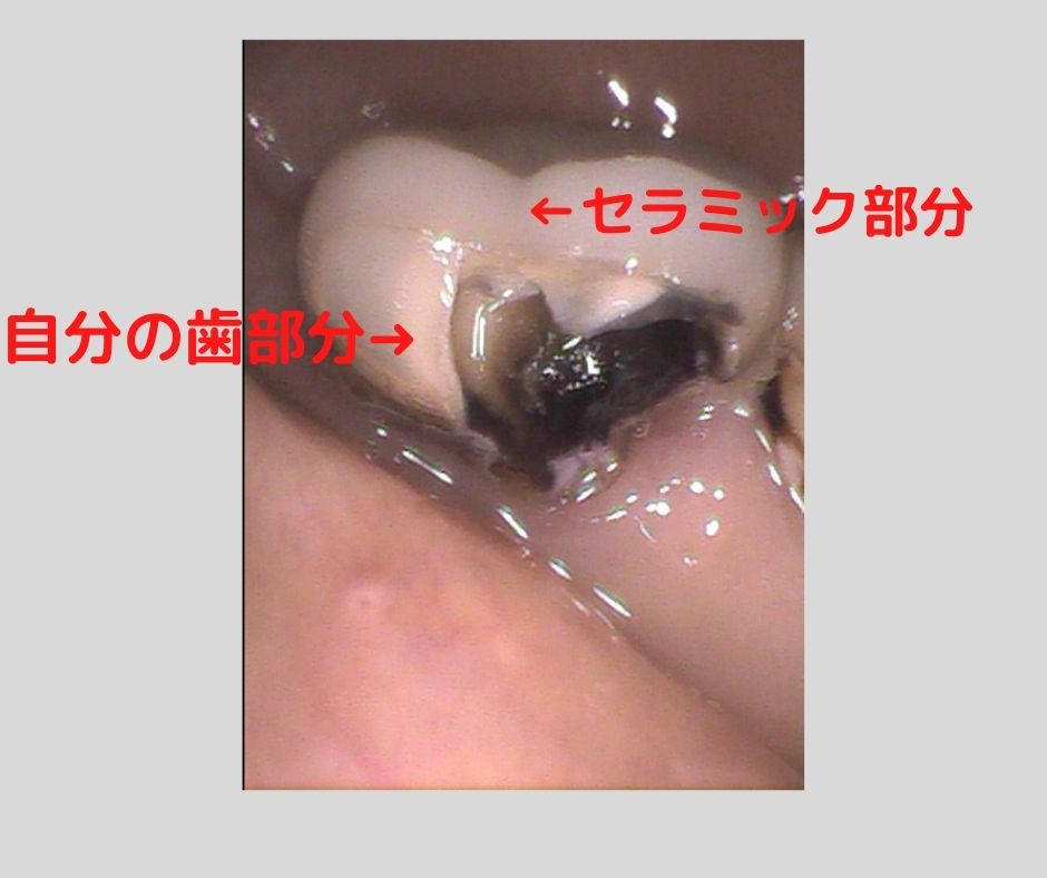 セラミックを入れた歯が痛む原因｜香川県 高松市 咬み合わせ専門 吉本歯科医院