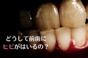 歯にヒビ・亀裂が入っている場合｜香川県高松市の吉本歯科医院