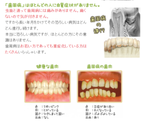 歯周病・歯槽膿漏の治療なら香川県高松市の吉本歯科医院