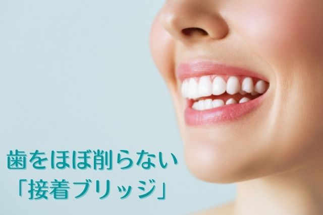 歯を削らない接着ブリッジ｜香川県高松市の吉本歯科医院