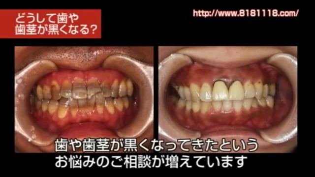 差し歯の歯茎が黒い・歯と歯茎の境目の黒ずみが気になる方へ｜高松市の吉本歯科医院