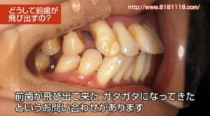前歯が出てきた｜高松市の吉本歯科医院