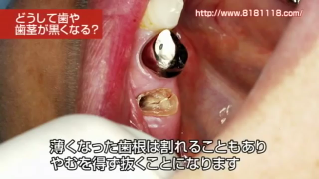 差し歯の歯茎が黒い・歯と歯茎の境目の黒ずみが気になる方へ｜高松市の吉本歯科医院
