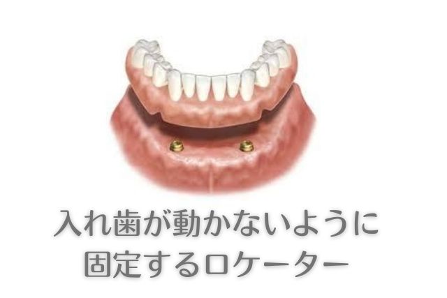 動かない入れ歯なら高松市の吉本歯科医院