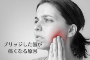 ブリッジした歯が痛くなる原因｜香川県高松市のインプラント治療なら吉本歯科医院