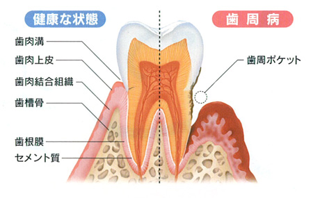 インプラント周囲炎とは｜香川県のインプラント治療なら吉本歯科医院