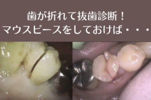 歯が折れて抜歯診断！歯根破折を予防するのはマウスピース｜高松市の吉本歯科医院