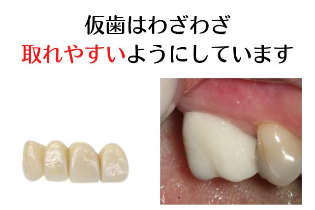 仮歯の重要性｜香川県高松市の咬み合わせ専門　吉本歯科医院