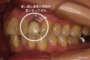 差し歯と歯茎の境目が黒くなった｜香川県高松市の吉本歯科医院