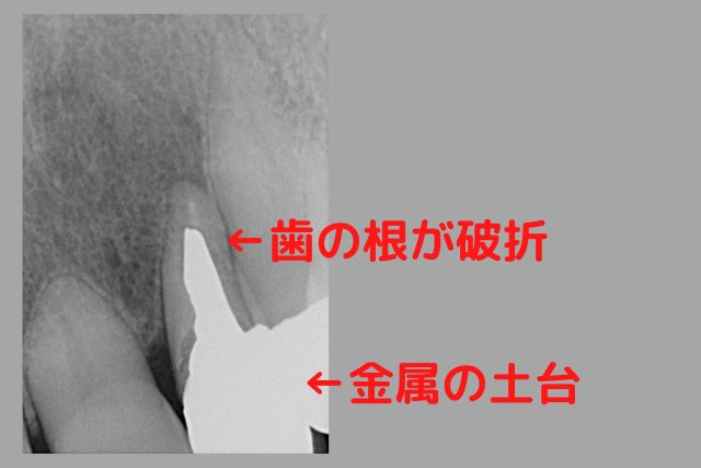 差し歯の土台が歯根破折で抜歯｜高松市の吉本歯科医院