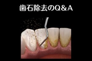歯石取りで歯茎が下がる｜高松市の吉本歯科医院