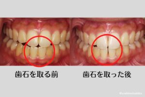 歯石を取った後に前歯に隙間ができた｜高松市の吉本歯科医院