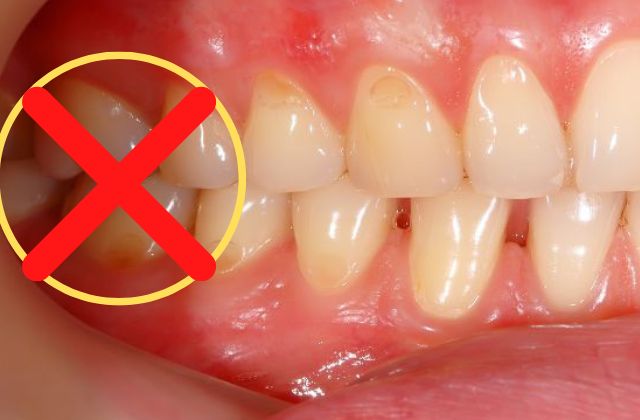歯を失った場合の３つの治療法|抜歯後の治療の解説｜高松市の吉本歯科医院