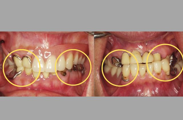 歯を失った場合の３つの治療法|抜歯後の治療の解説｜高松市の吉本歯科医院