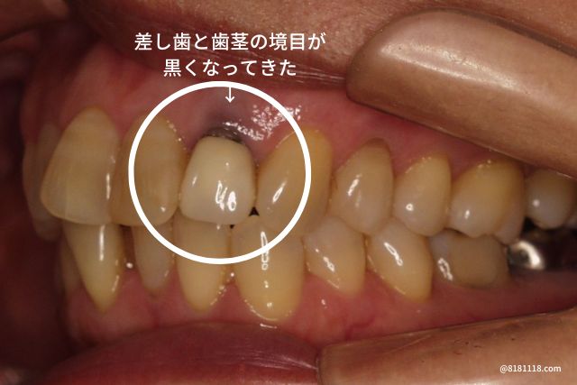 差し歯ってなに？香川県高松市の前歯の差し歯なら咬み合わせ専門吉本歯科医院
